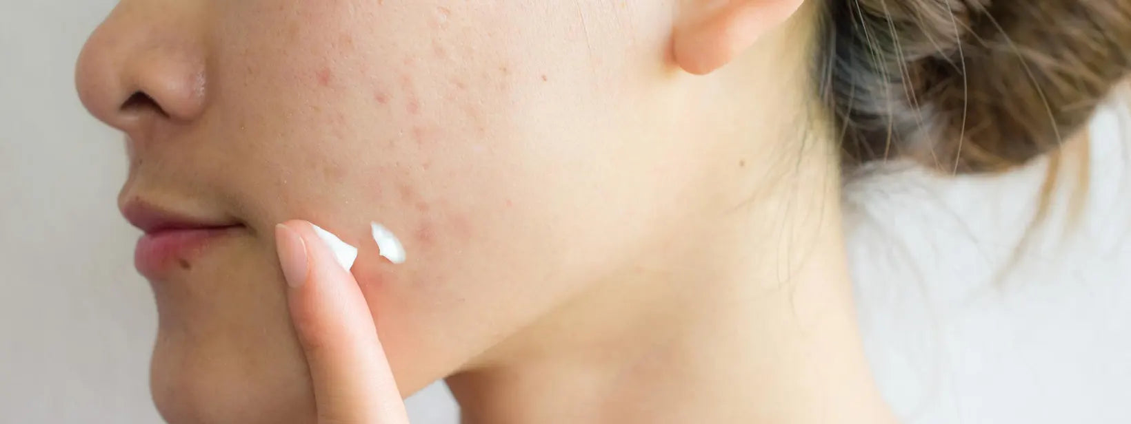What is Acne?