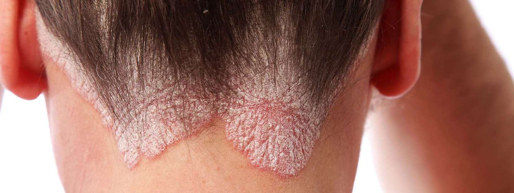 Understanding Psoriasis